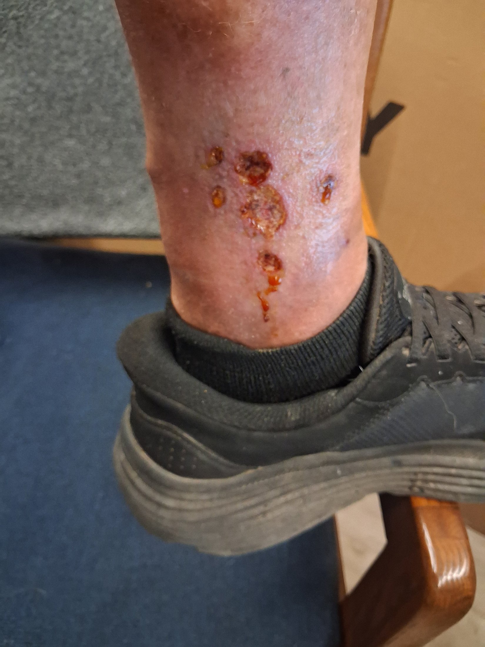 After 5 and 6 months of these wounds not healing, it's time to leave allopathic medicine in the dust it deserves to be in and try something modern and new.